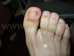 Лечение вросшего ногтя на ноге ростов на дону thumbnail